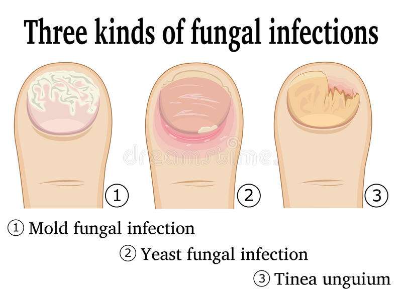 Simptomi gljivične infekcije