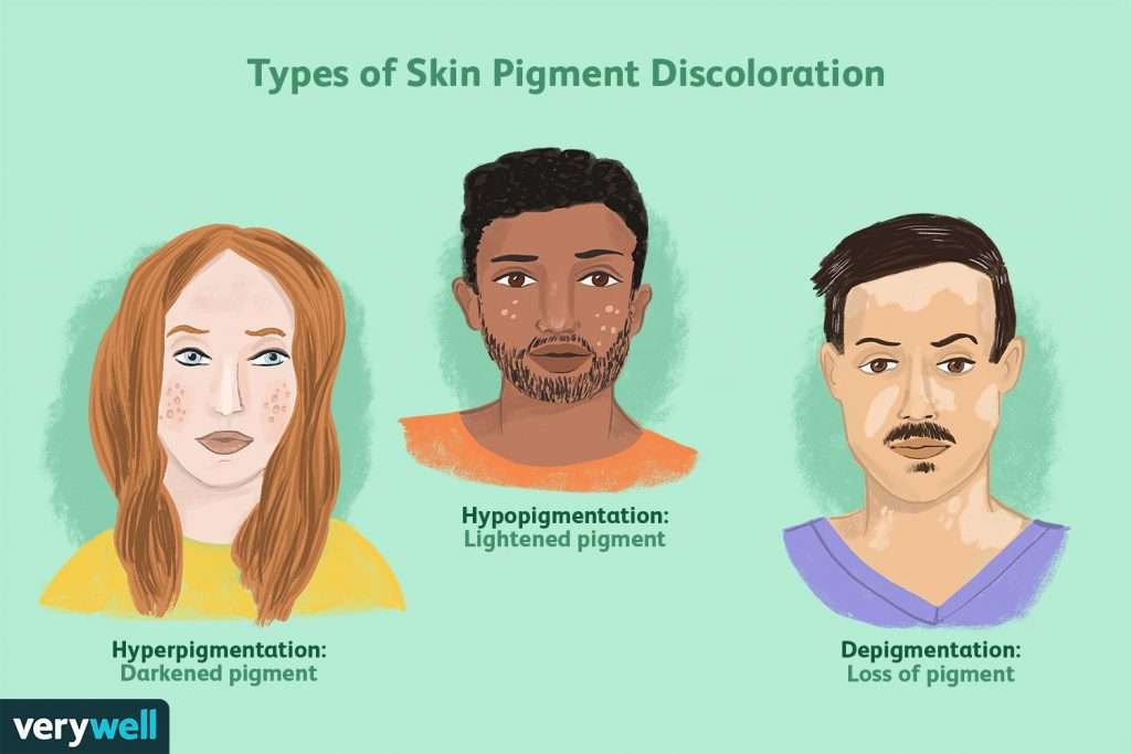 Co je pigmentace